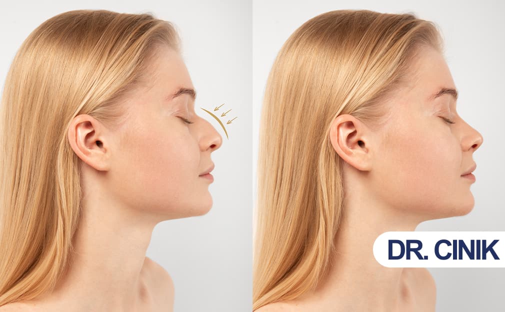 Burun Dolgusu Nedir?